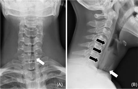 normal soft tissue neck x-ray